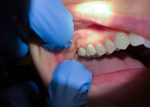 Best Emergency Tooth Extraction in Crescent, OK